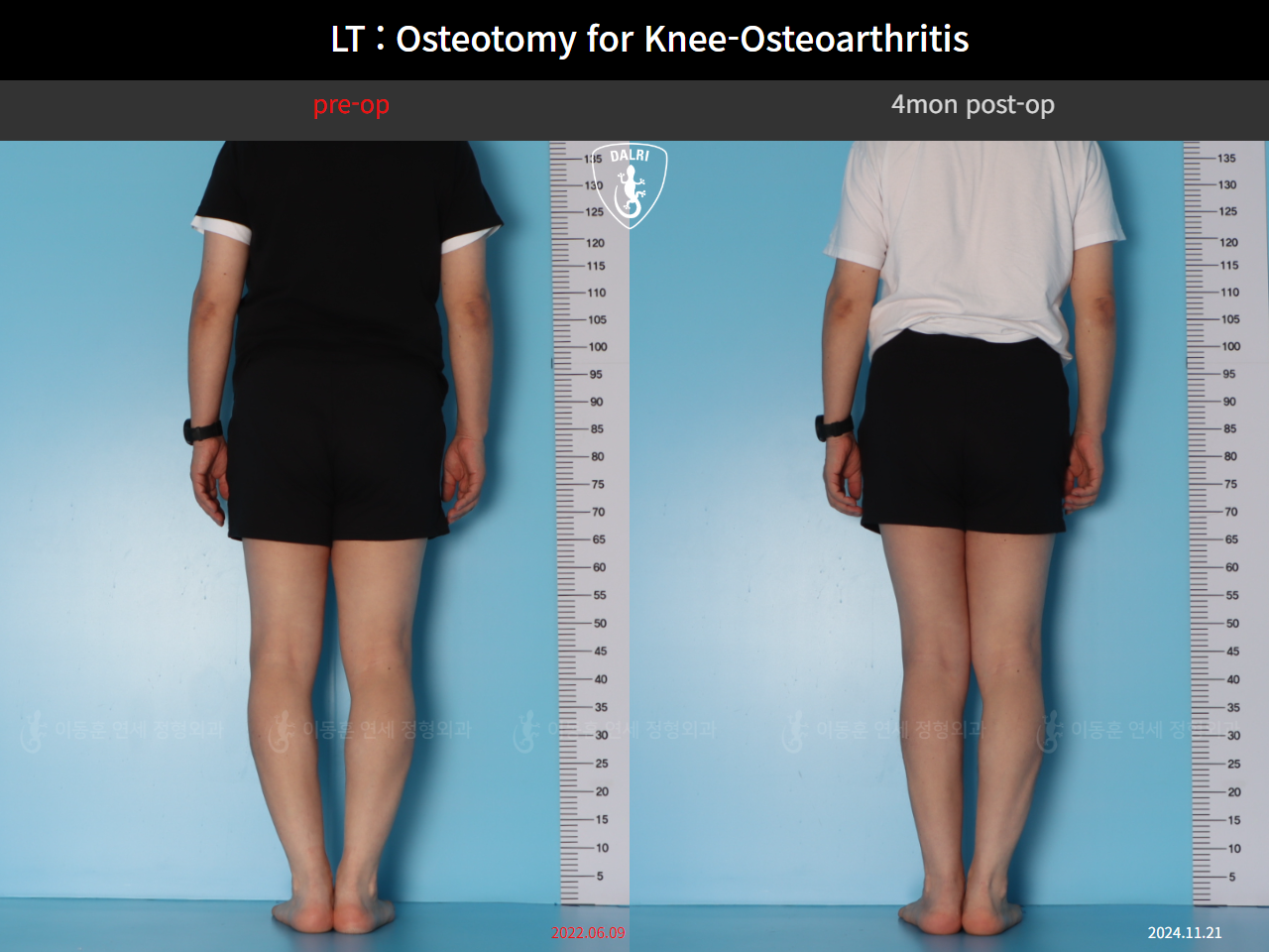 Before and after osteotomy for knee osteoarthritis, case 128374850, image 5, Dr. Donghoon institute (DALRI)