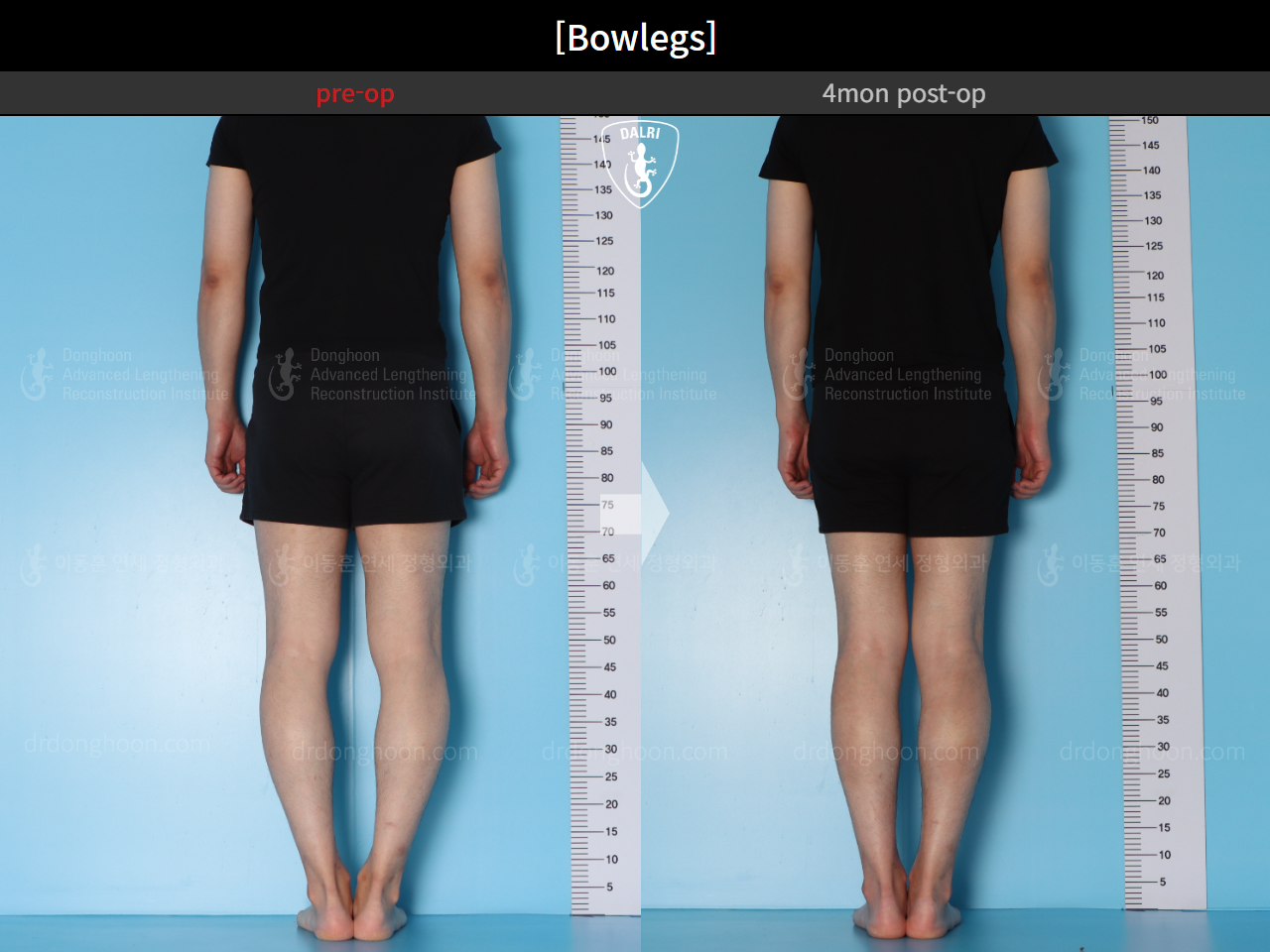 Before and after adult bowlegs, case 15650289, image 4, Dr. Donghoon institute (DALRI)