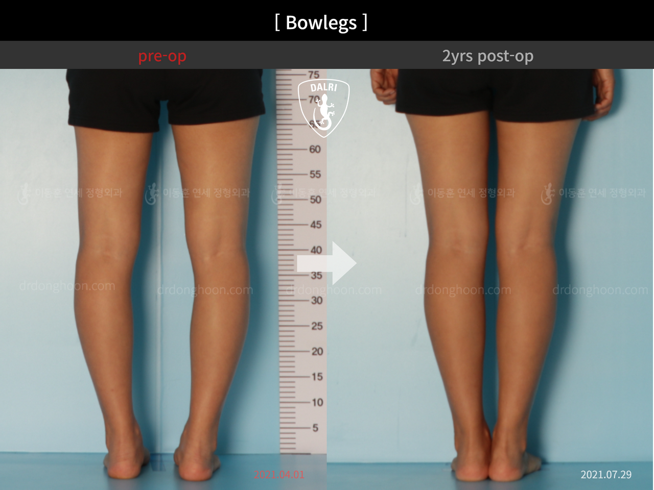 Before and after adult bowlegs, case 12060396, image 6, Dr. Donghoon institute (DALRI)