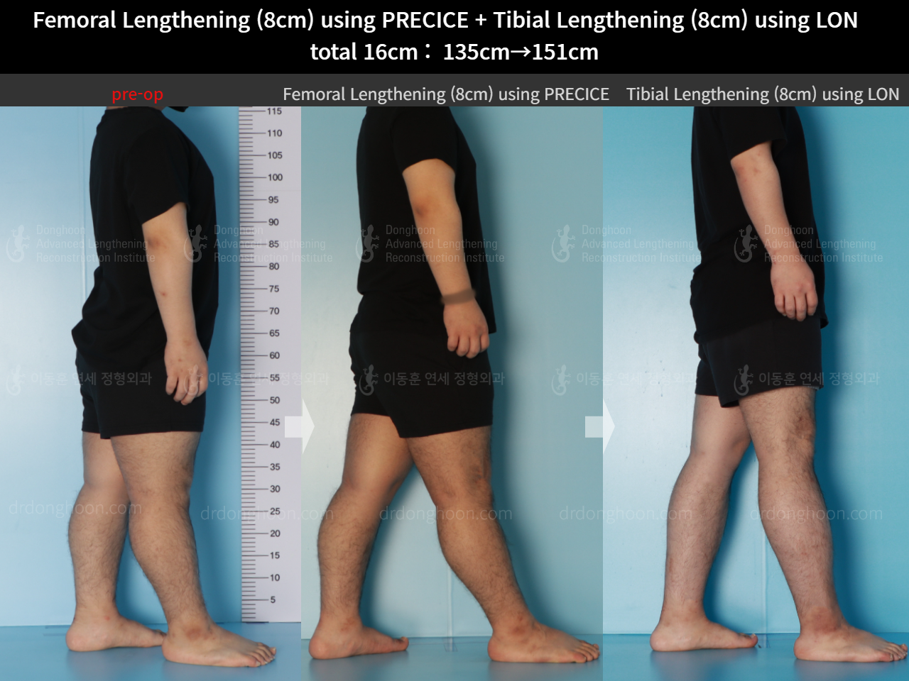 Before and after cll lon, case 16524730, image 4, Dr. Donghoon institute (DALRI)