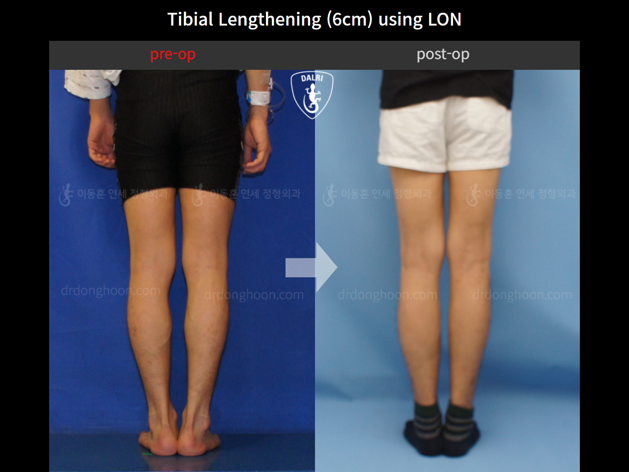 Before and after cll lon, case 4323477, image 4, Dr. Donghoon institute (DALRI)