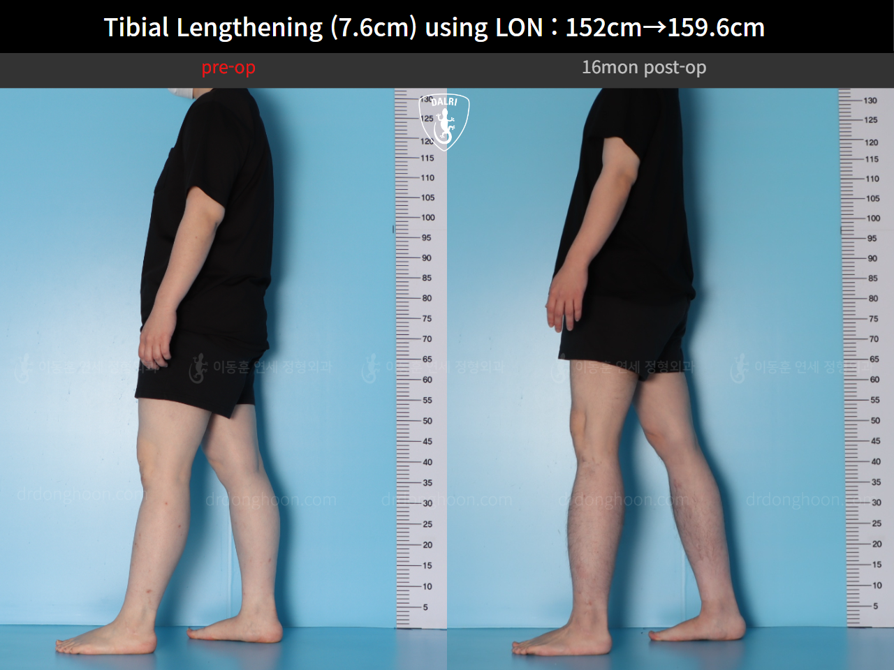 Before and after cll lon, case 123804178, image 3, Dr. Donghoon institute (DALRI)