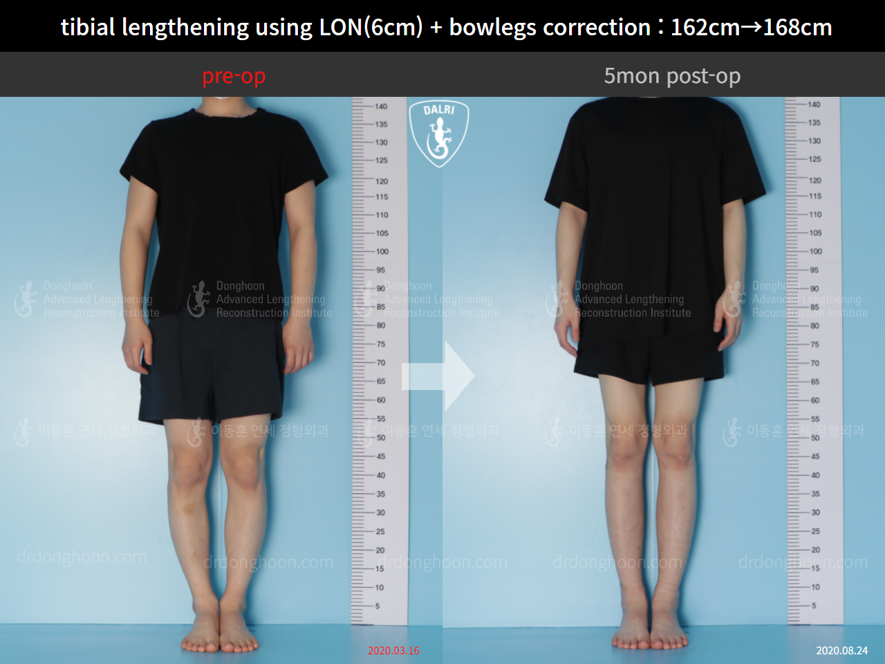Before and after cll + deformity correction, case 5316038, image 1, Dr. Donghoon institute (DALRI)