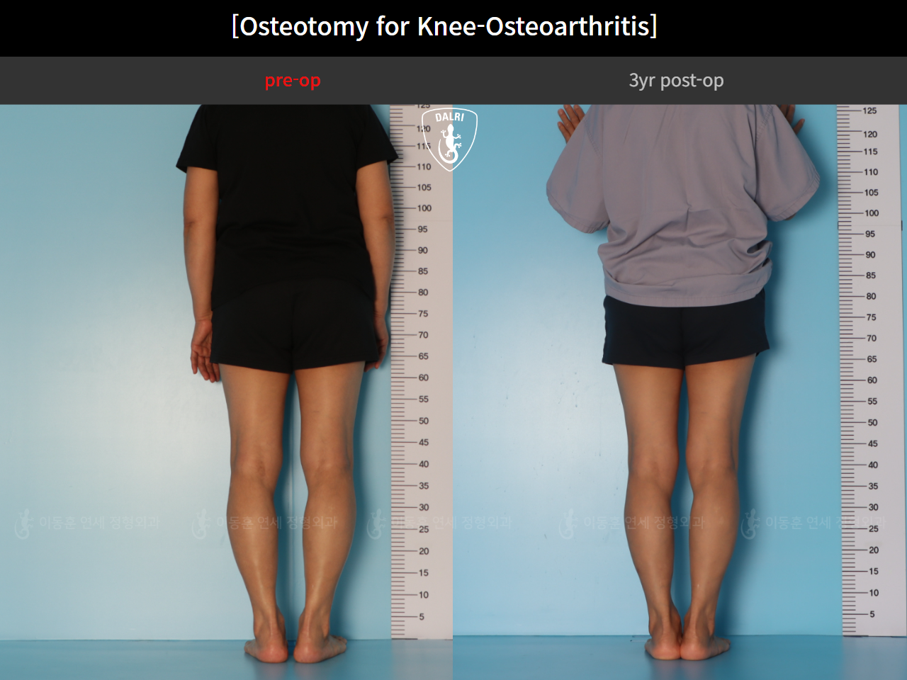 Before and after osteotomy for knee osteoarthritis, case 85842641, image 4, Dr. Donghoon institute (DALRI)
