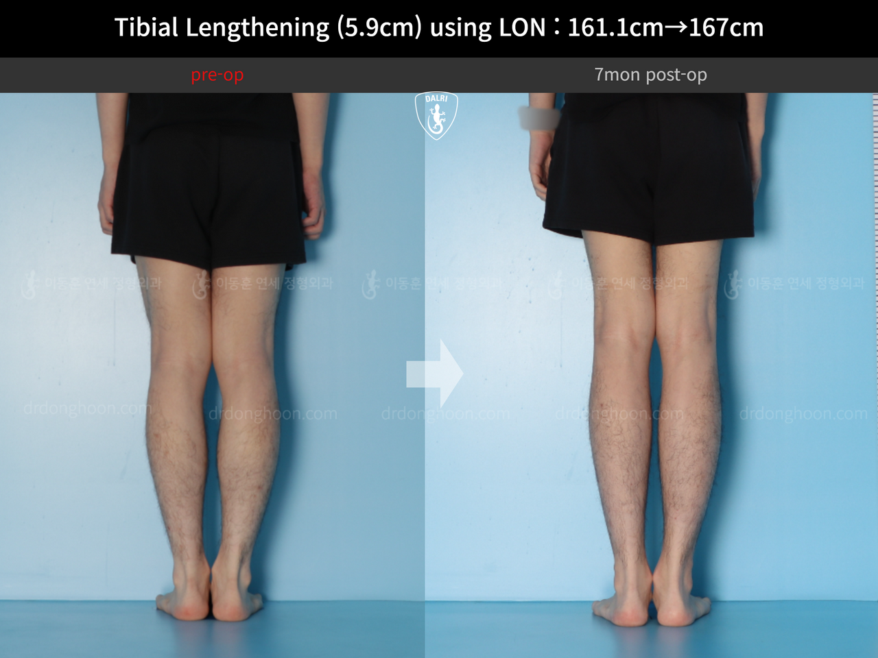 Before and after cll lon, case 14064750, image 7, Dr. Donghoon institute (DALRI)