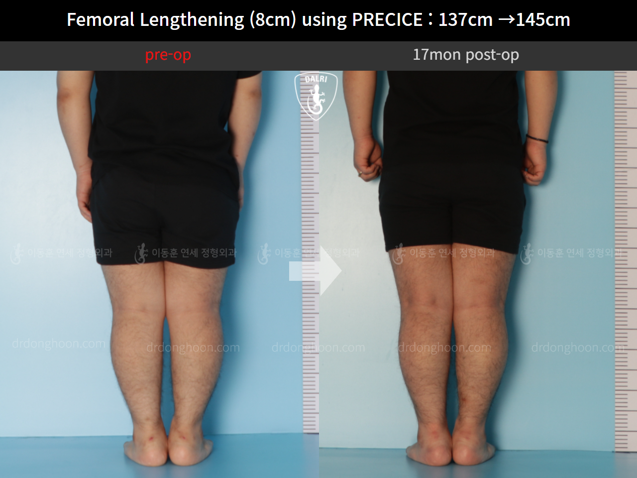 Before and after cll precice, case 9658893, image 6, Dr. Donghoon institute (DALRI)
