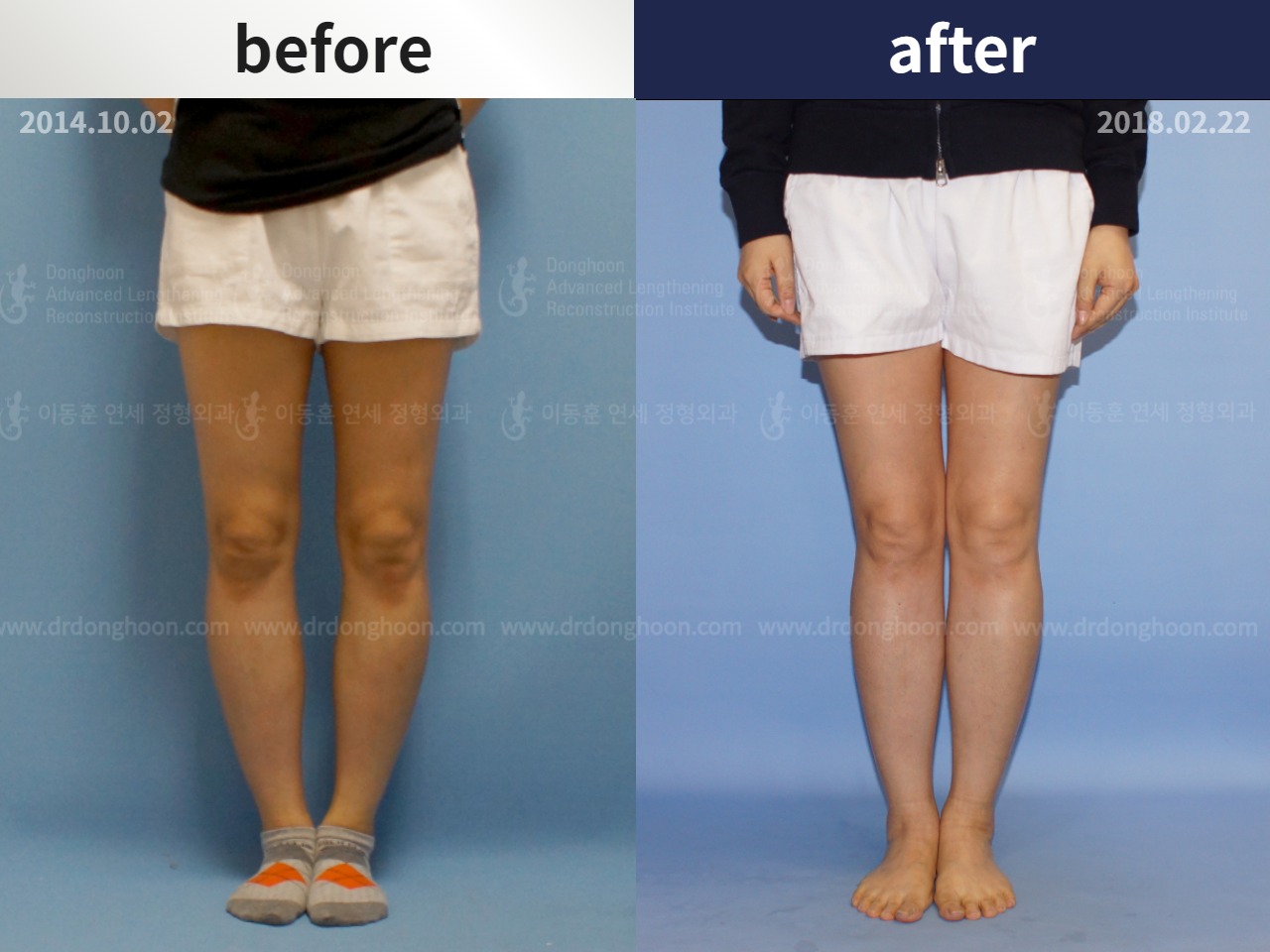 Before and after adult bowlegs, case 4586167, image 1, Dr. Donghoon institute (DALRI)