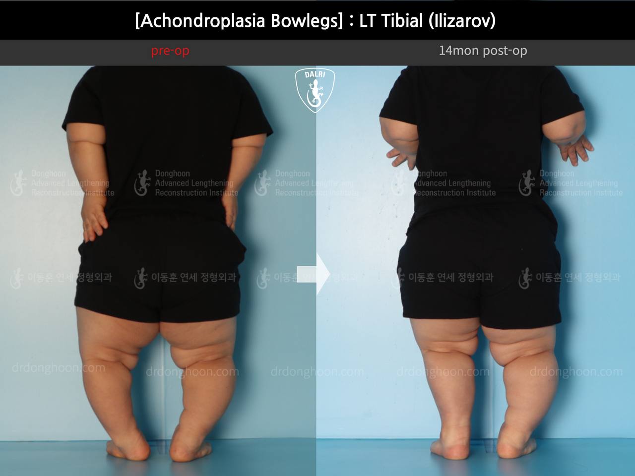 Before and after congenital condition, case 14296141, image 5, Dr. Donghoon institute (DALRI)