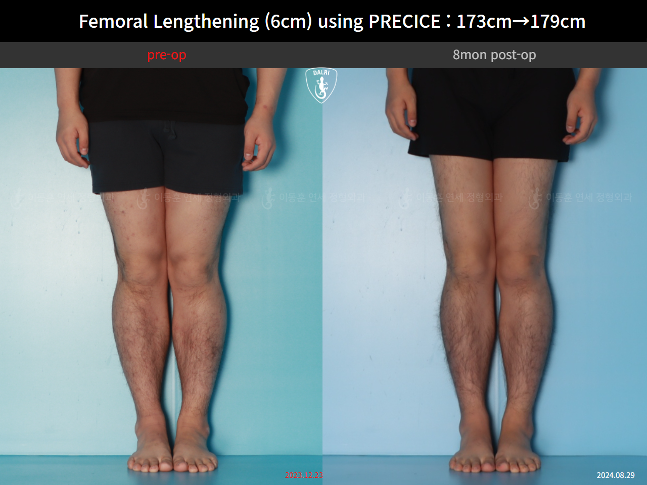 Before and after cll precice, case 89066969, image 7, Dr. Donghoon institute (DALRI)