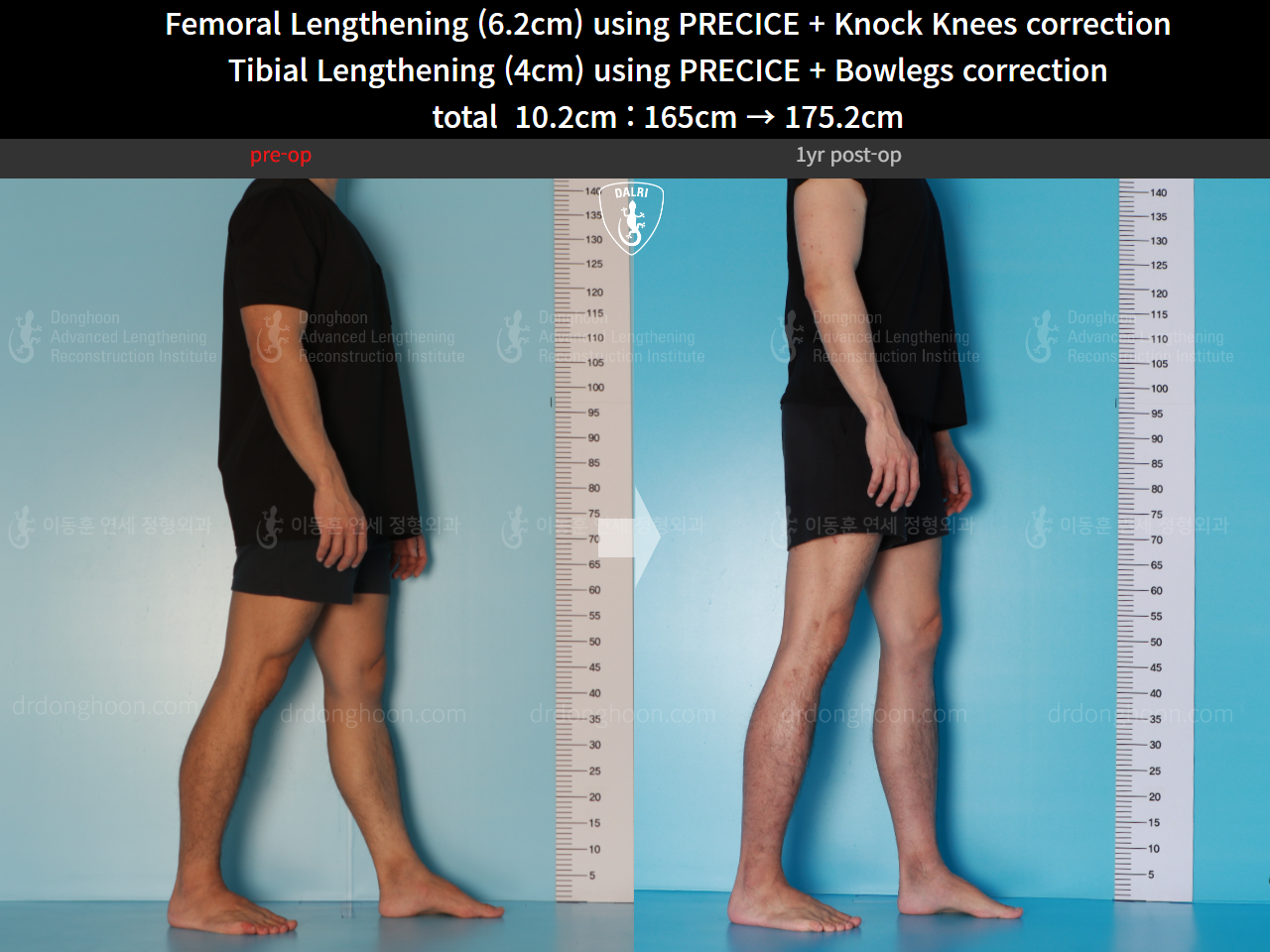 Before and after cll precice, case 15903274, image 8, Dr. Donghoon institute (DALRI)