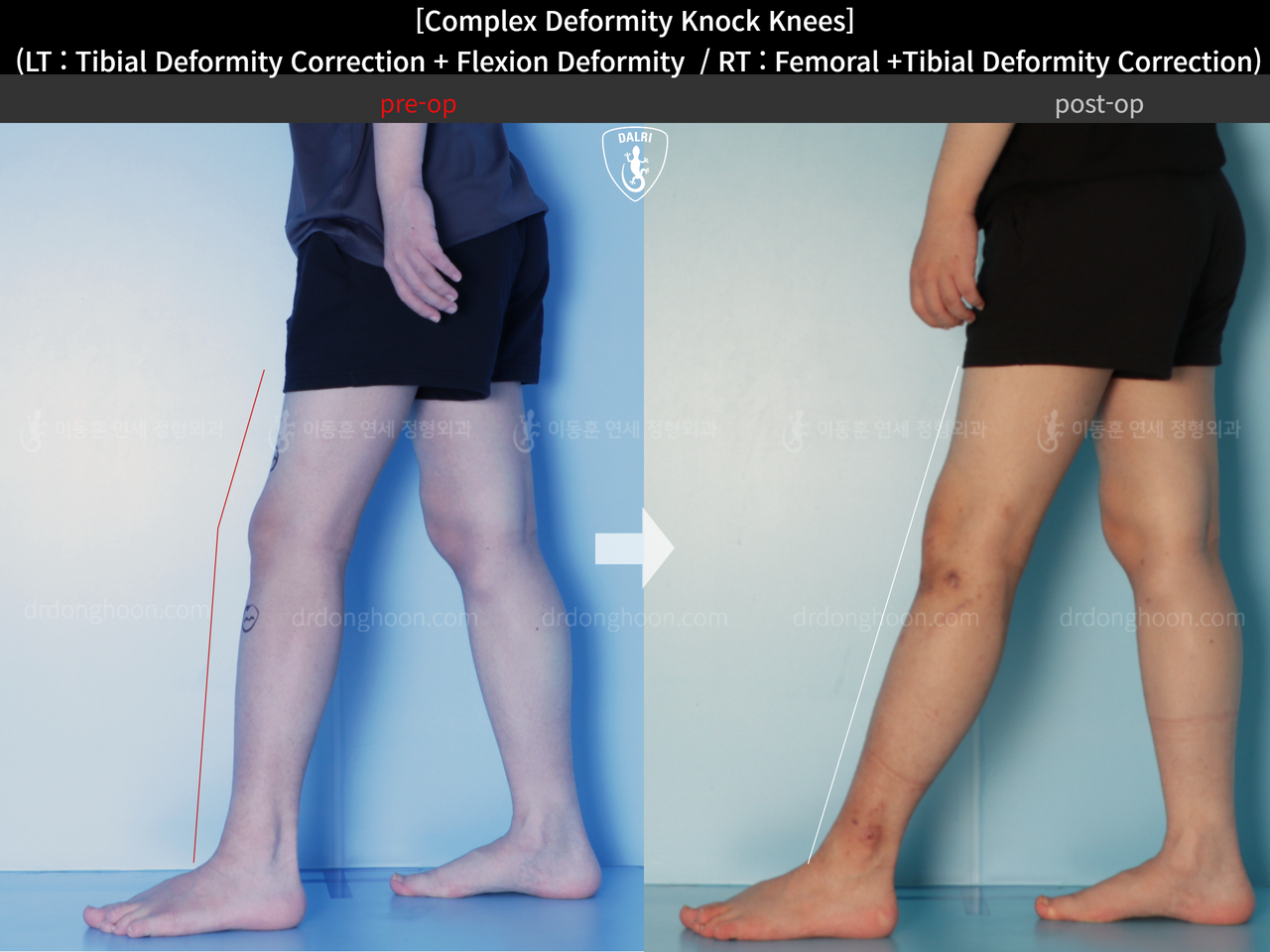 Before and after complex deformity, case 14439350, image 8, Dr. Donghoon institute (DALRI)