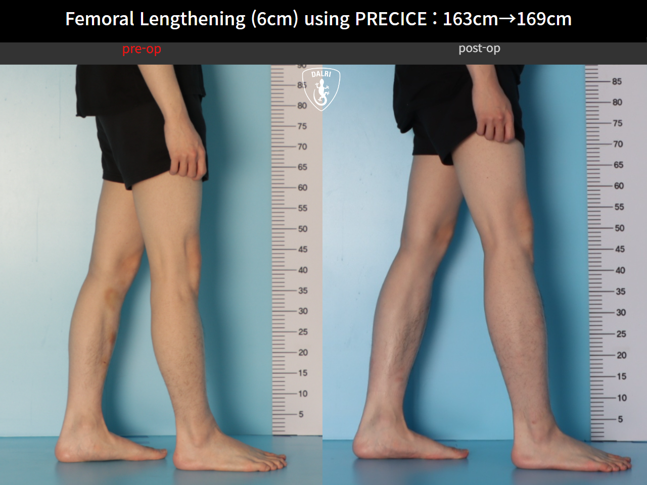 Before and after cll precice, case 33545760, image 7, Dr. Donghoon institute (DALRI)