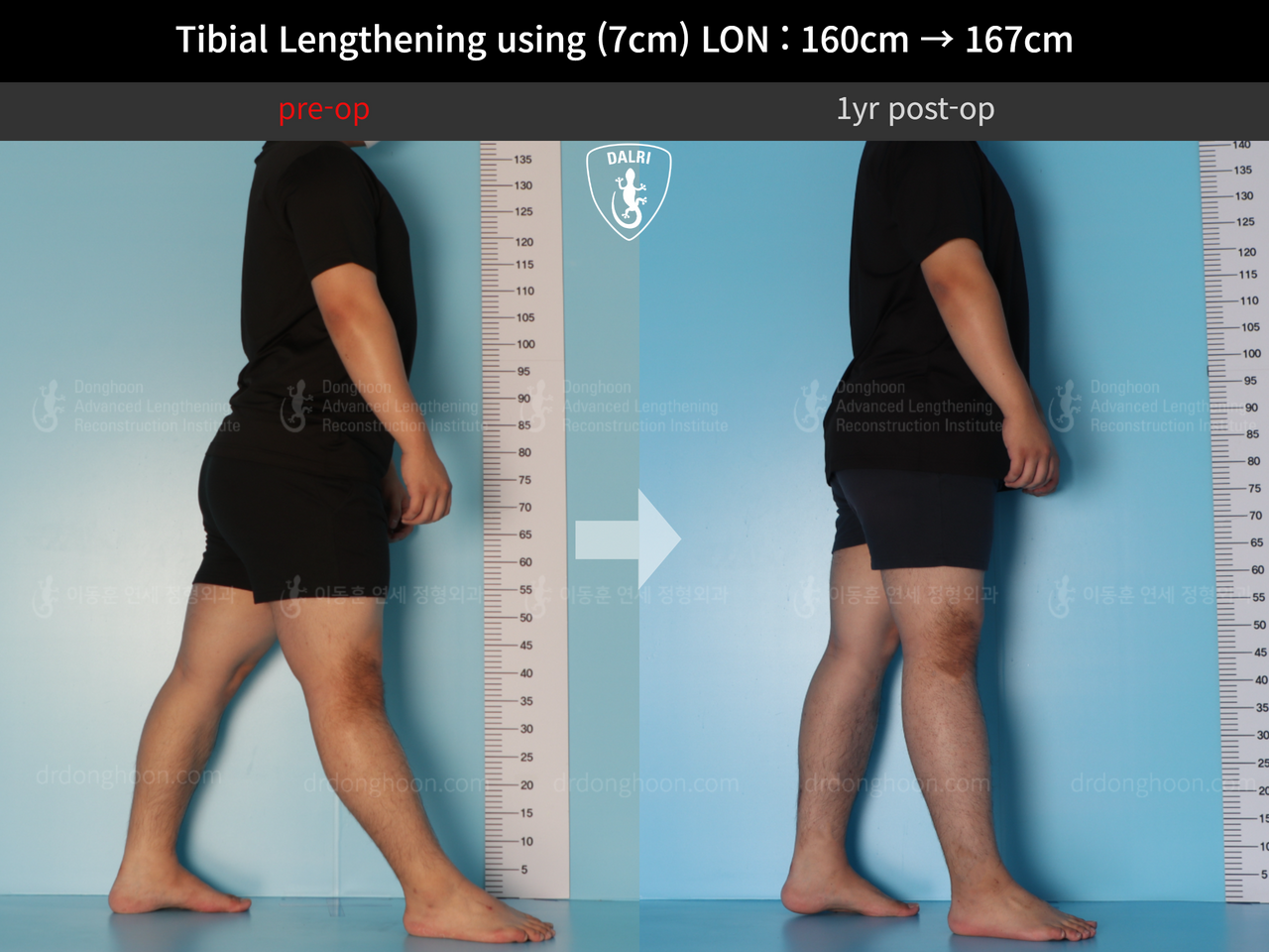 Before and after cll lon, case 12395704, image 3, Dr. Donghoon institute (DALRI)