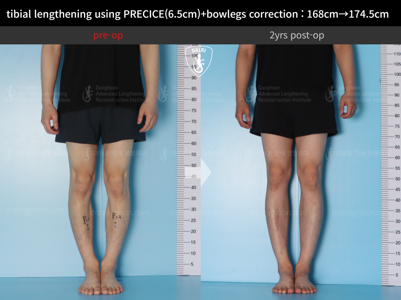 Before and after cll precice, case 12409993, image 6, Dr. Donghoon institute (DALRI)