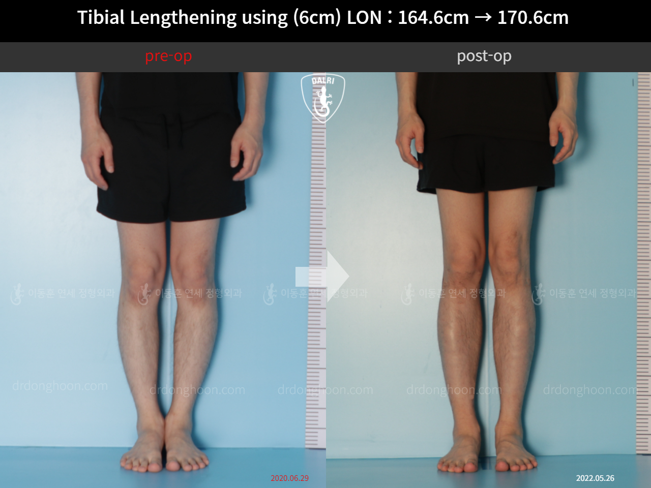 Before and after cll lon, case 11674504, image 6, Dr. Donghoon institute (DALRI)