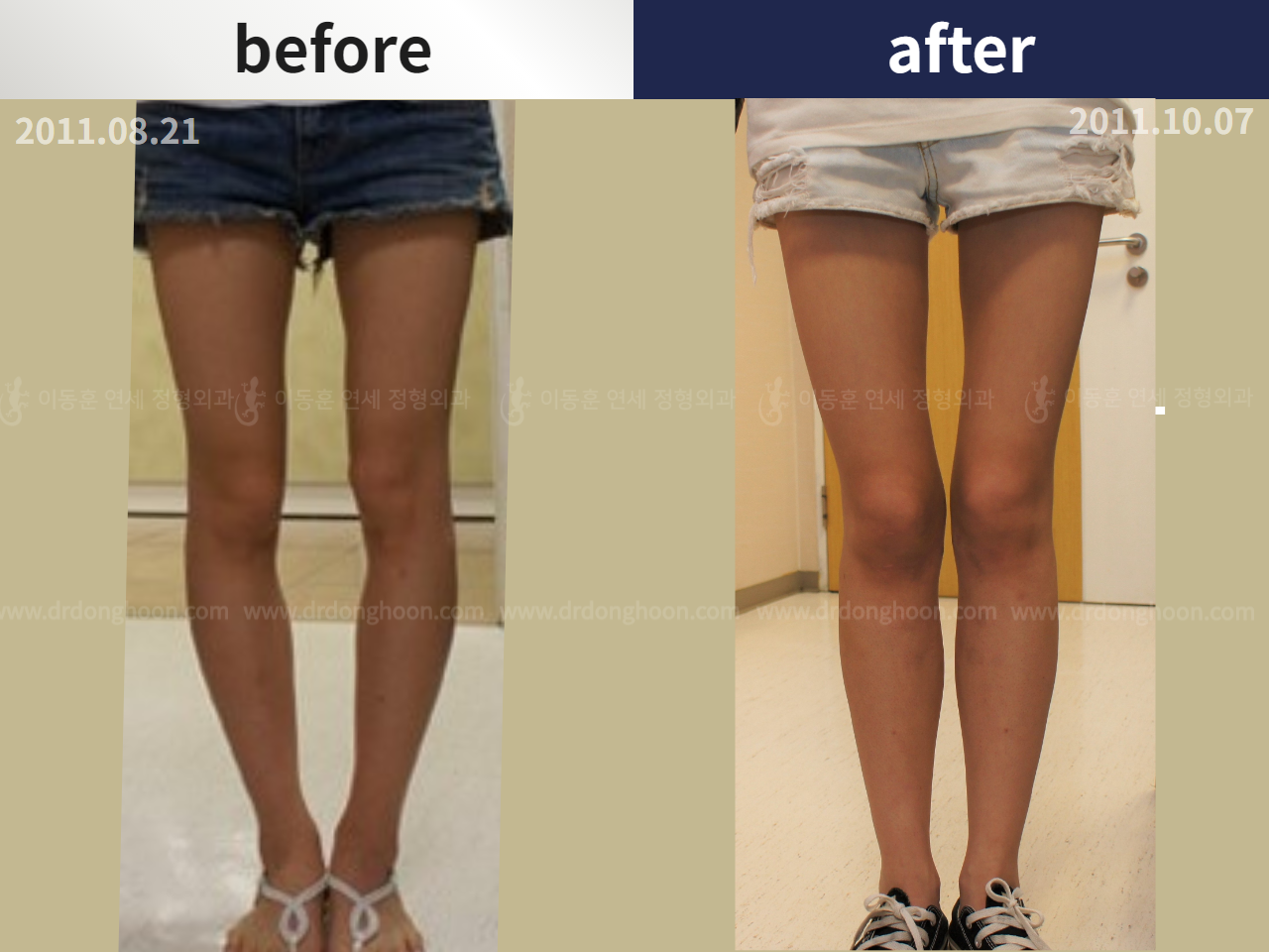 Before and after paediatric & adolescent bowlegs, case 4320281, image 1, Dr. Donghoon institute (DALRI)
