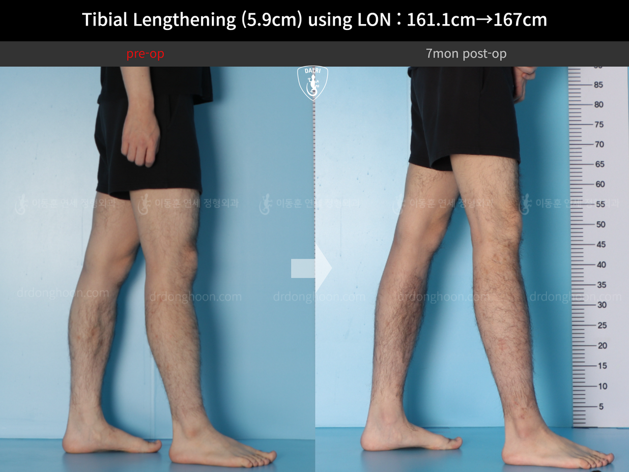 Before and after cll lon, case 14064750, image 9, Dr. Donghoon institute (DALRI)
