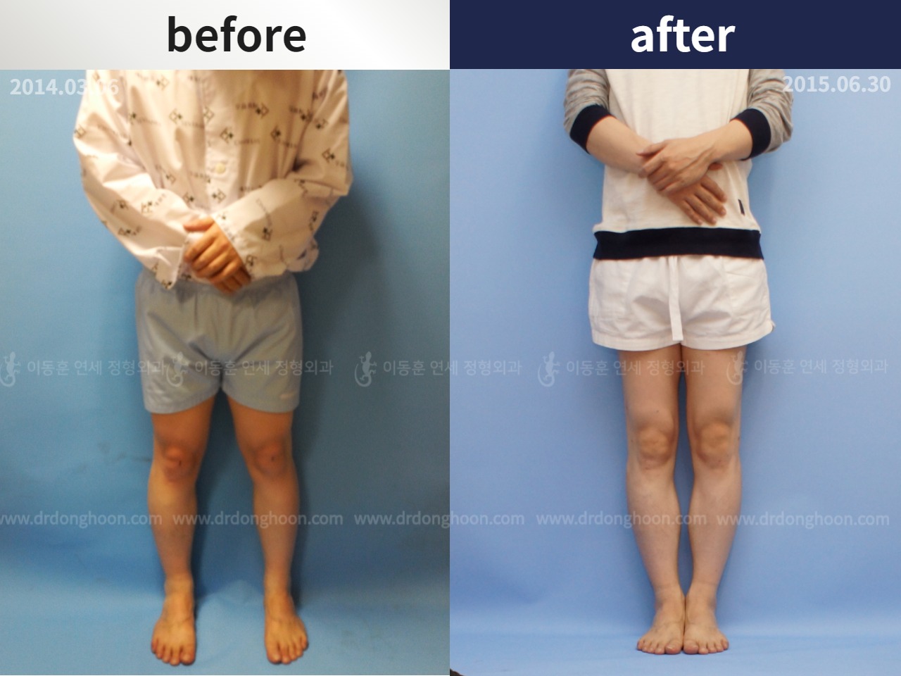 Before and after cll precice, case 4323355, image 1, Dr. Donghoon institute (DALRI)