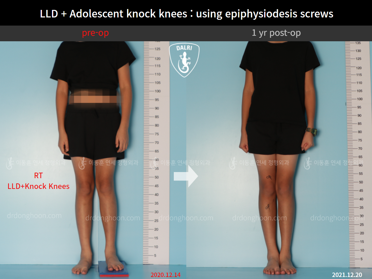 Before and after paediatric & adolescent knock knees, case 9186061, image 5, Dr. Donghoon institute (DALRI)