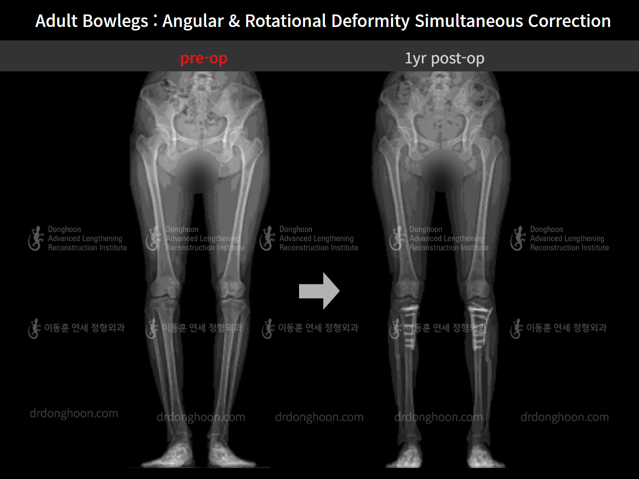 Before and after adult bowlegs, case 9058125, image 7, Dr. Donghoon institute (DALRI)