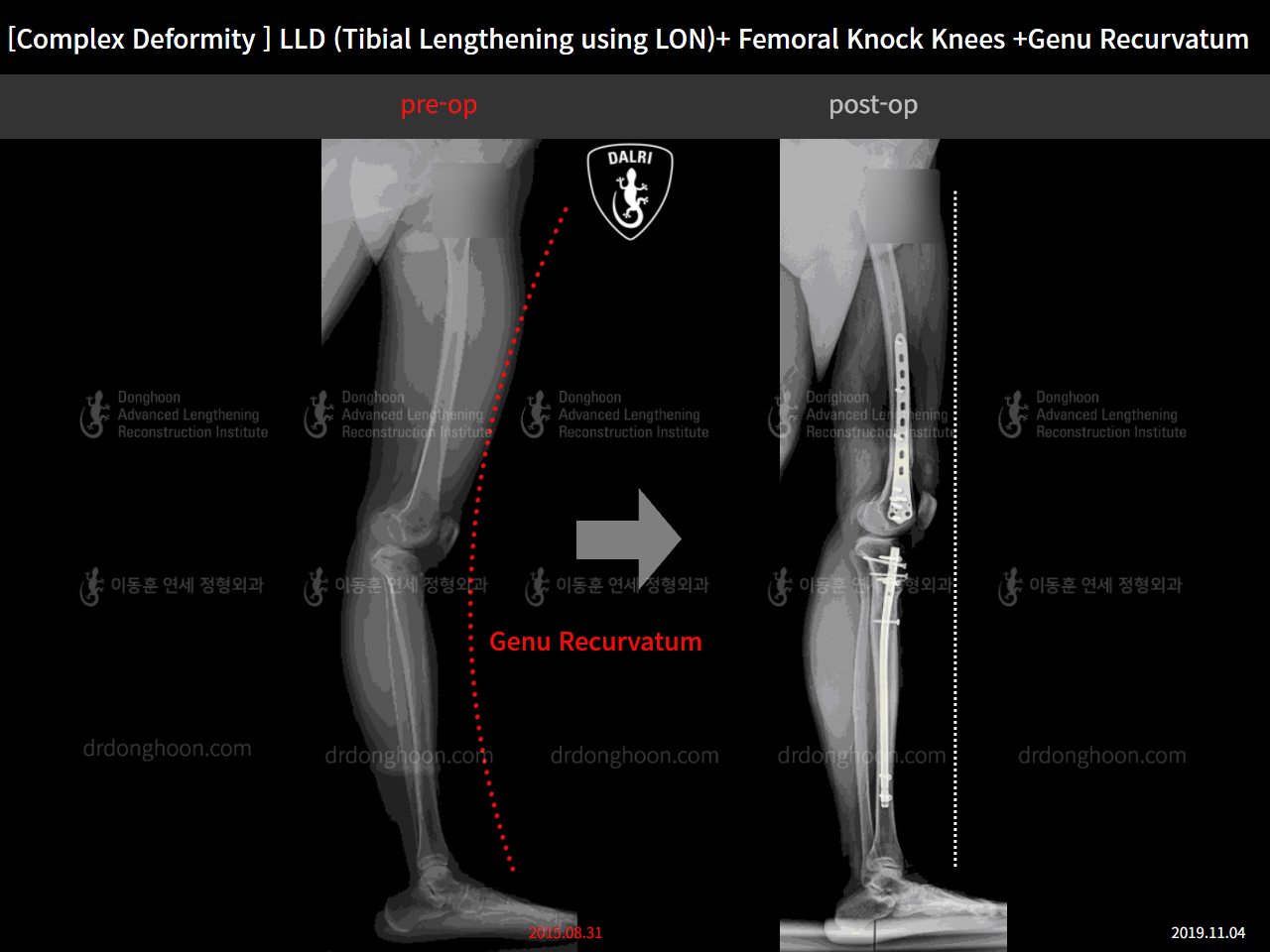 Before and after adult lld, case 4320339, image 7, Dr. Donghoon institute (DALRI)