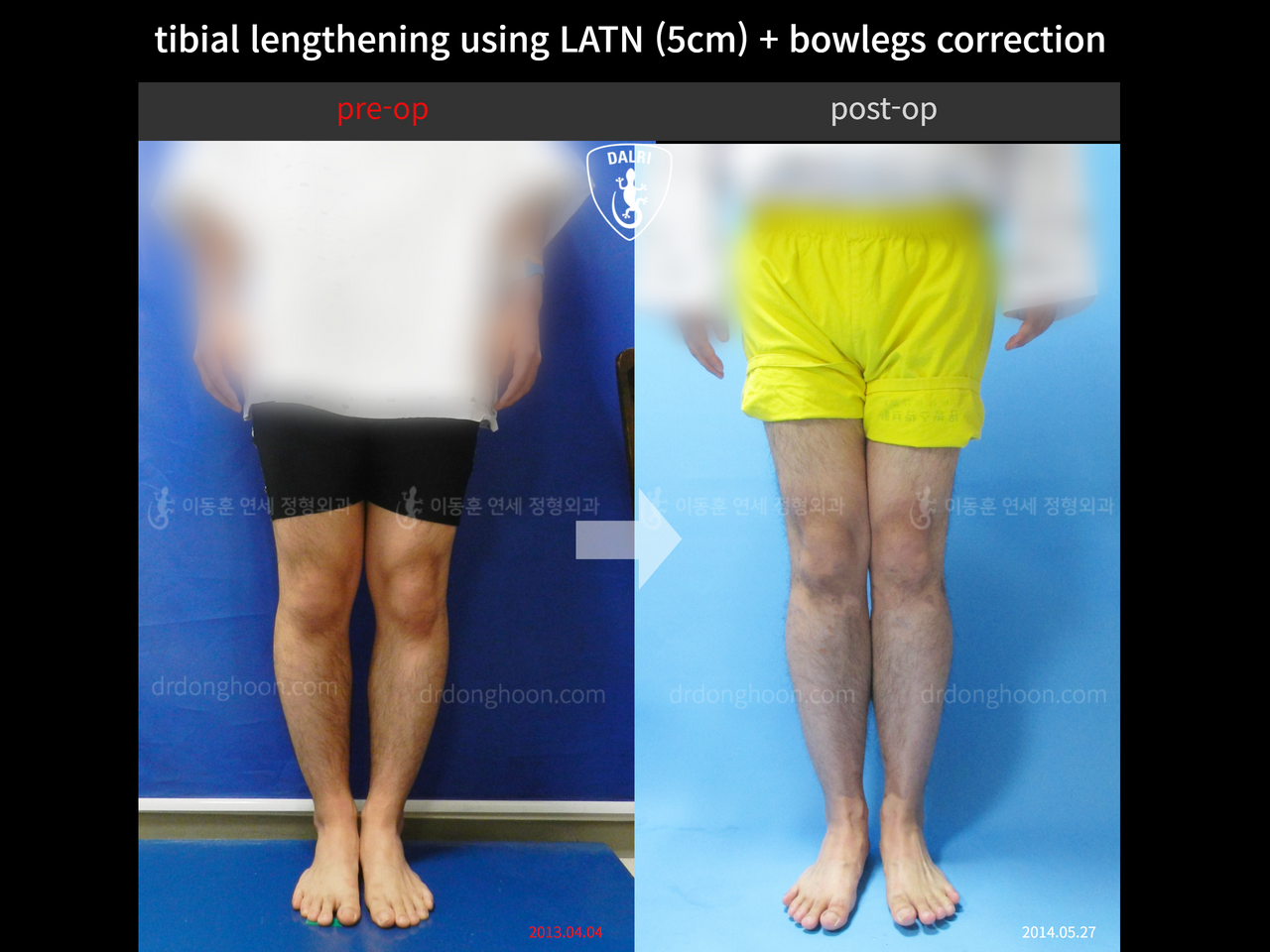Before and after cll + deformity correction, case 4323109, image 1, Dr. Donghoon institute (DALRI)
