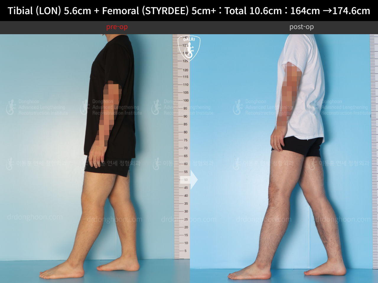 Before and after cll precice, case 13942494, image 8, Dr. Donghoon institute (DALRI)
