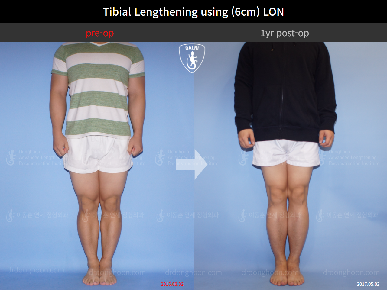 Before and after cll lon, case 4323461, image 1, Dr. Donghoon institute (DALRI)