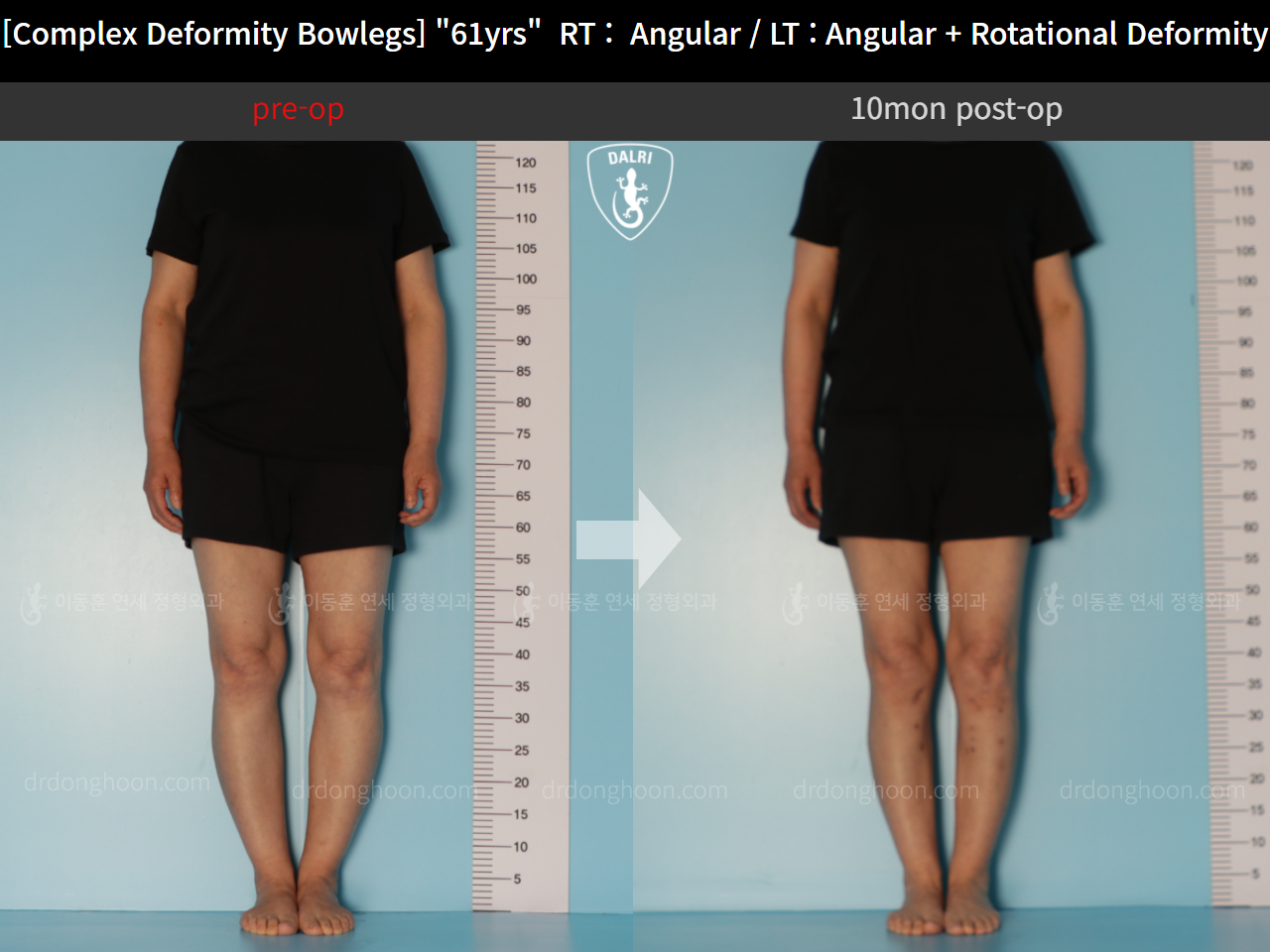 Before and after osteotomy for knee osteoarthritis, case 11576611, image 3, Dr. Donghoon institute (DALRI)