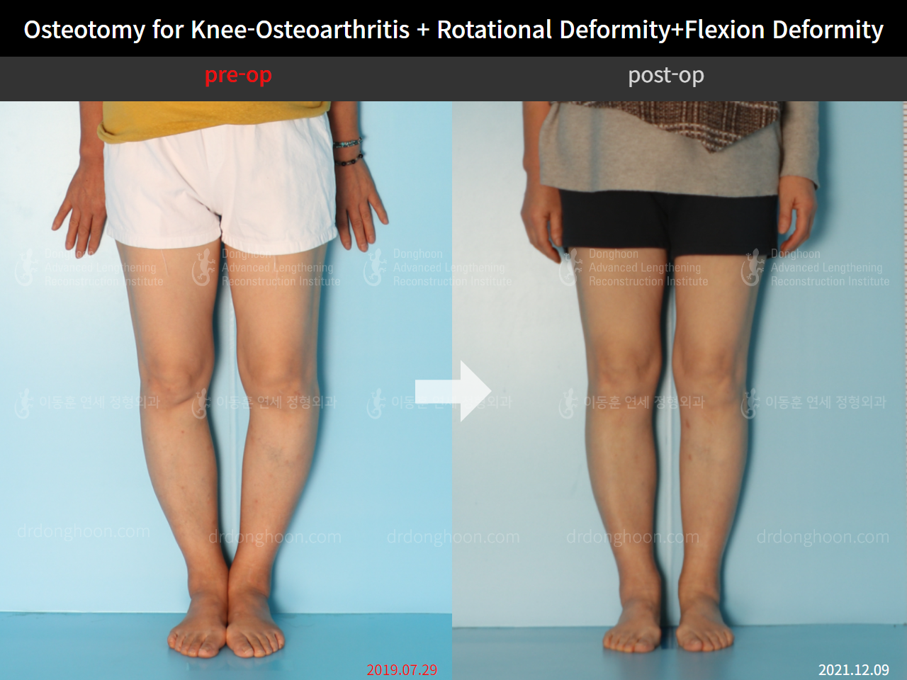Before and after osteotomy for knee osteoarthritis, case 5987662, image 4, Dr. Donghoon institute (DALRI)