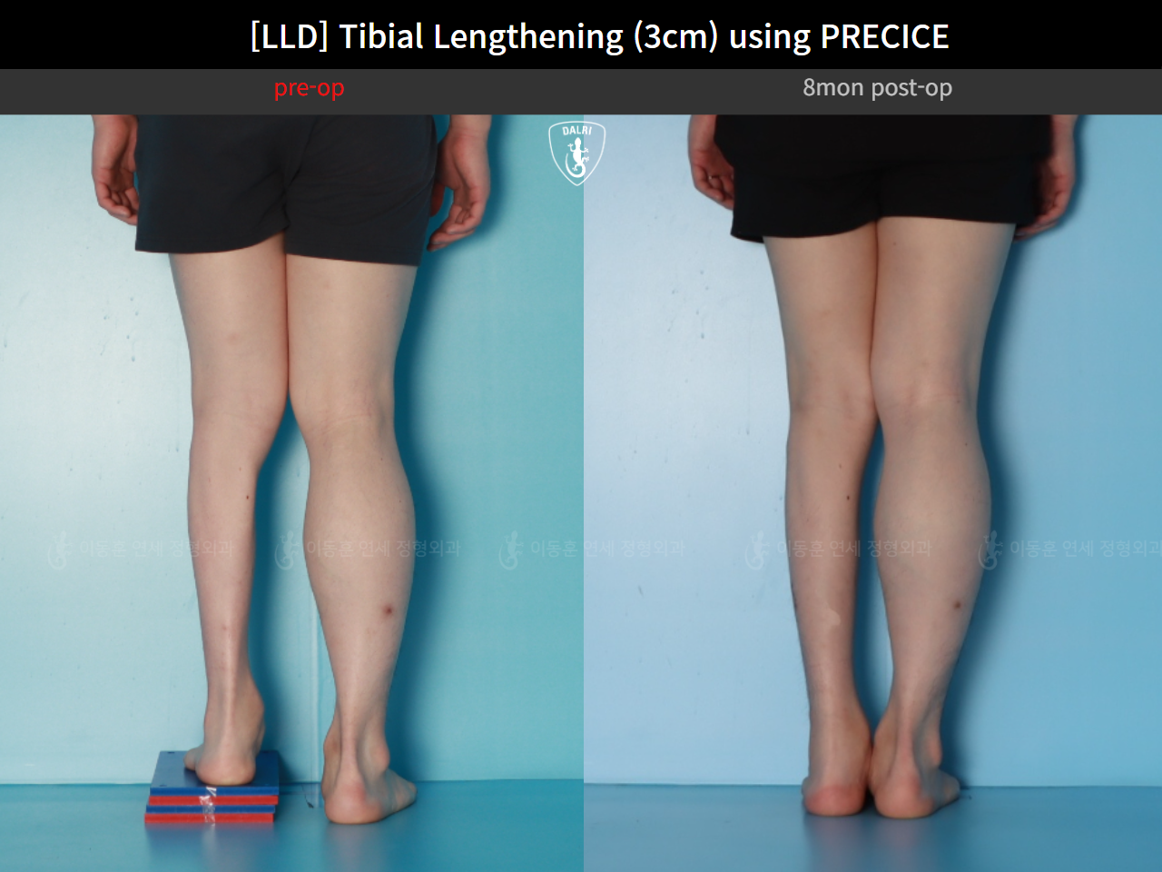 Before and after adult lld, case 124813877, image 6, Dr. Donghoon institute (DALRI)