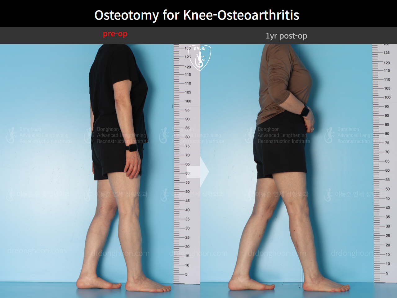 Before and after osteotomy for knee osteoarthritis, case 16893966, image 5, Dr. Donghoon institute (DALRI)