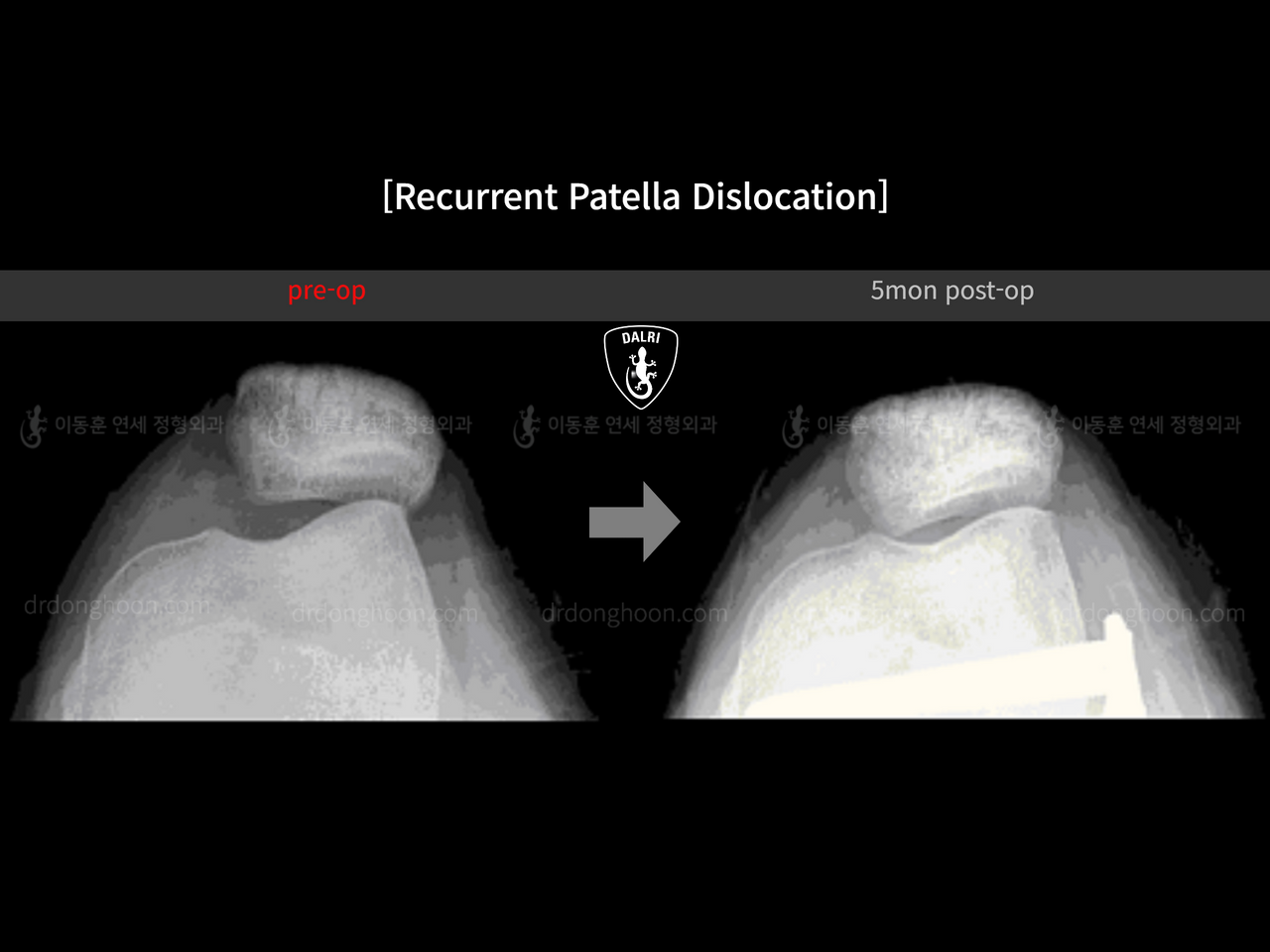Before and after recurrent patella dislocation, case 13337596, image 8, Dr. Donghoon institute (DALRI)