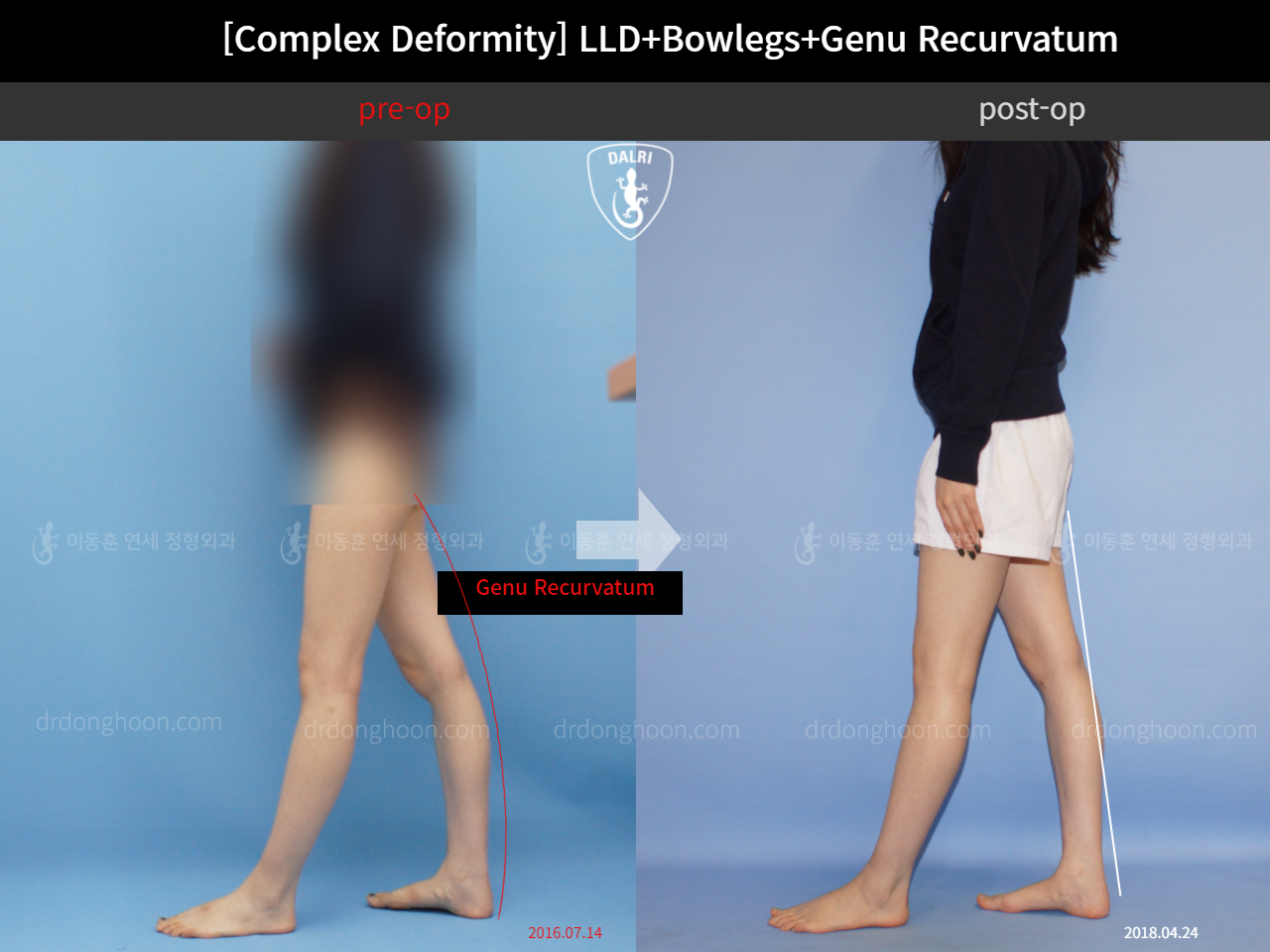 Before and after adult lld, case 11648318, image 3, Dr. Donghoon institute (DALRI)