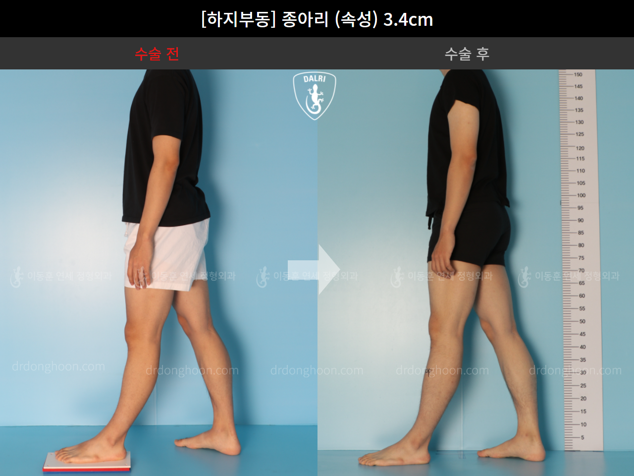 Before and after adult lld, case 4585742, image 3, Dr. Donghoon institute (DALRI)