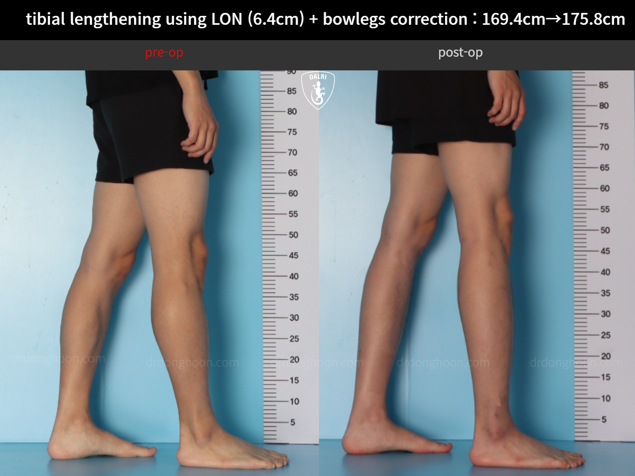 Before and after cll + deformity correction, case 36736776, image 9, Dr. Donghoon institute (DALRI)