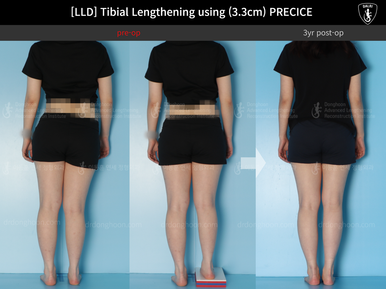 Before and after adult lld, case 14064905, image 2, Dr. Donghoon institute (DALRI)