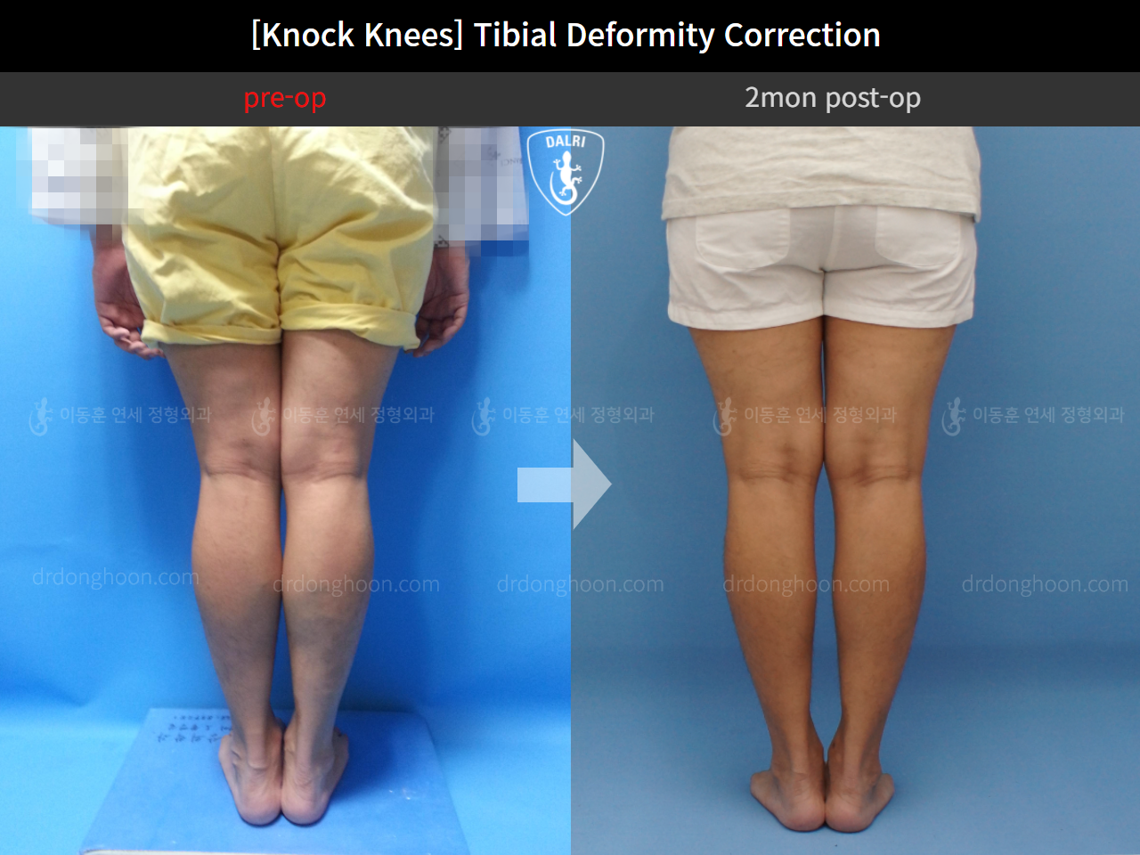 Before and after adult knock knees, case 4310814, image 4, Dr. Donghoon institute (DALRI)