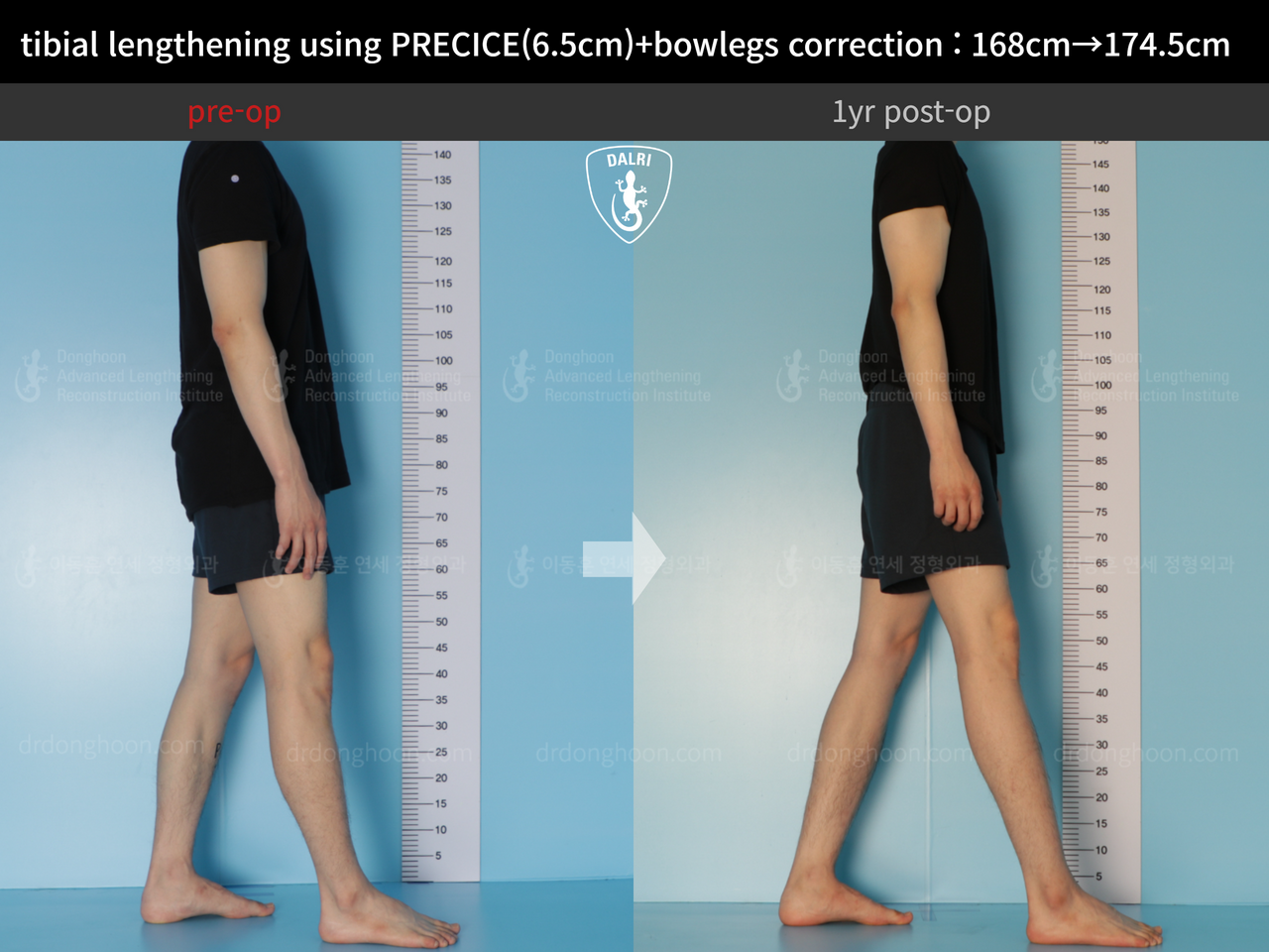 Before and after cll precice, case 12409993, image 5, Dr. Donghoon institute (DALRI)