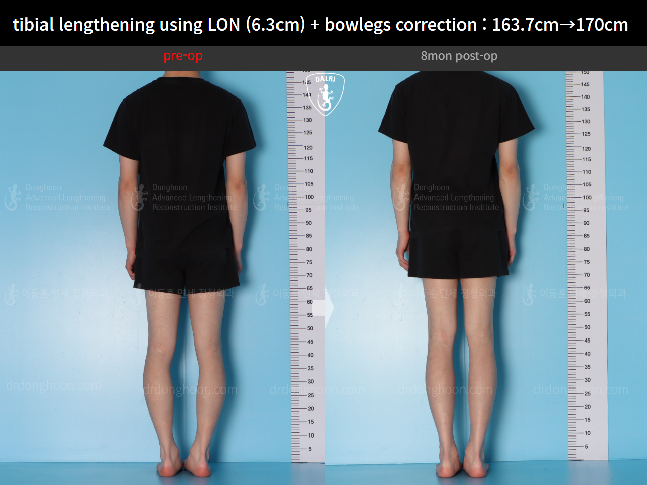 Before and after cll + deformity correction, case 16853829, image 4, Dr. Donghoon institute (DALRI)