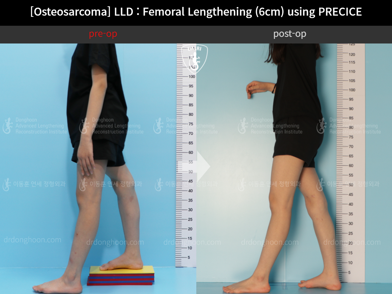 Before and after adult lld, case 11378041, image 2, Dr. Donghoon institute (DALRI)