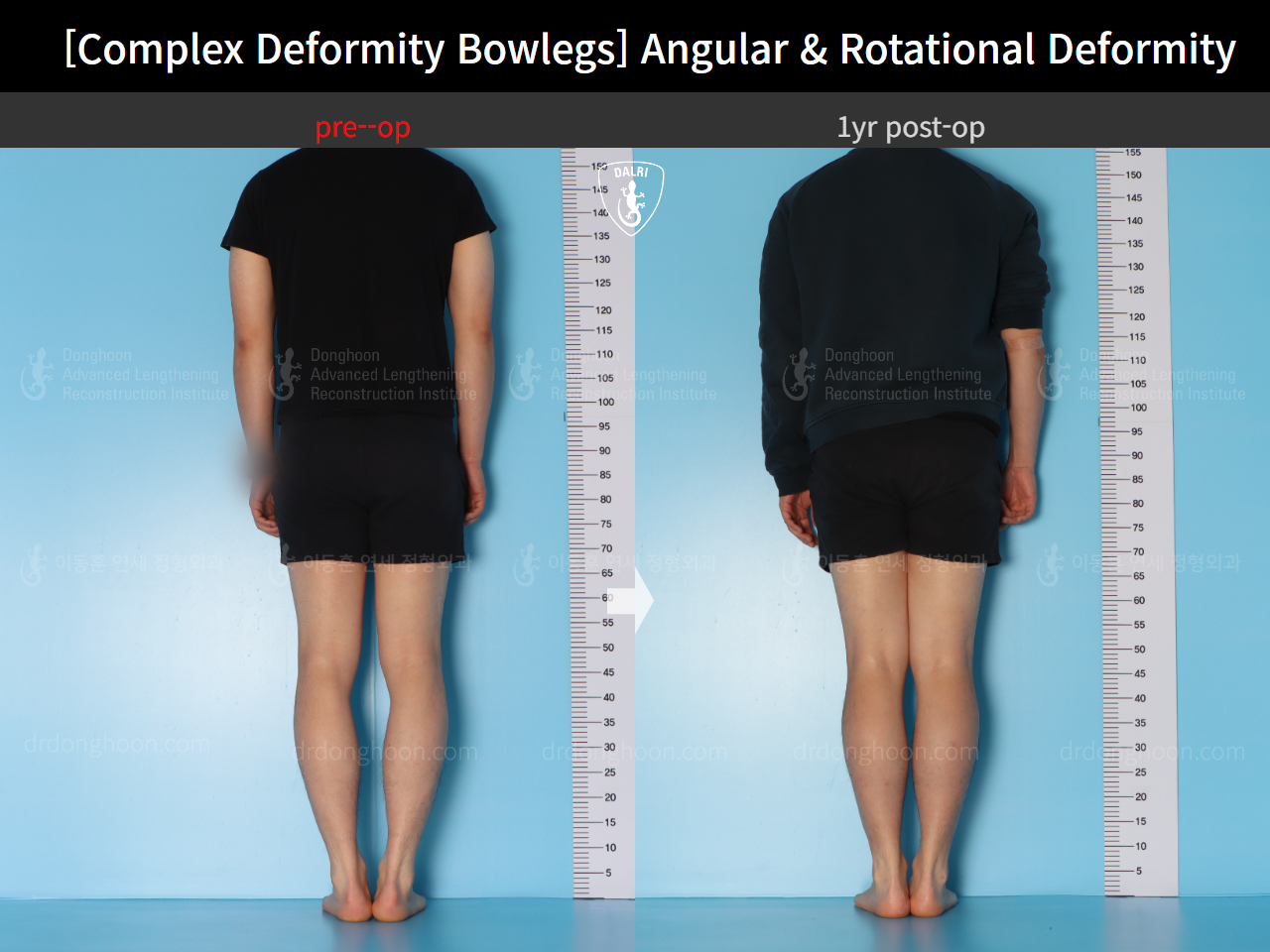 Before and after adult bowlegs, case 17229195, image 3, Dr. Donghoon institute (DALRI)
