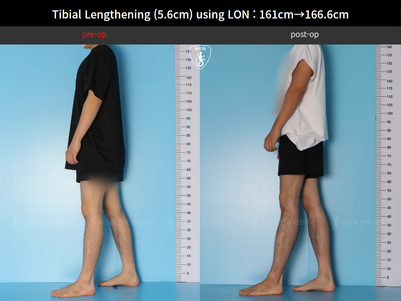 Before and after cll lon, case 126542150, image 3, Dr. Donghoon institute (DALRI)