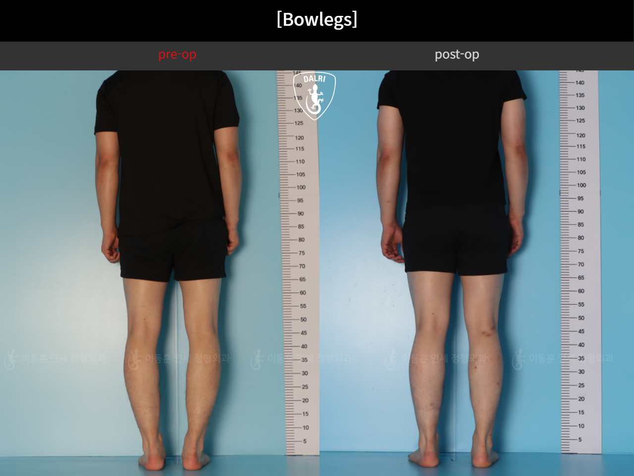 Before and after adult bowlegs, case 44111770, image 5, Dr. Donghoon institute (DALRI)
