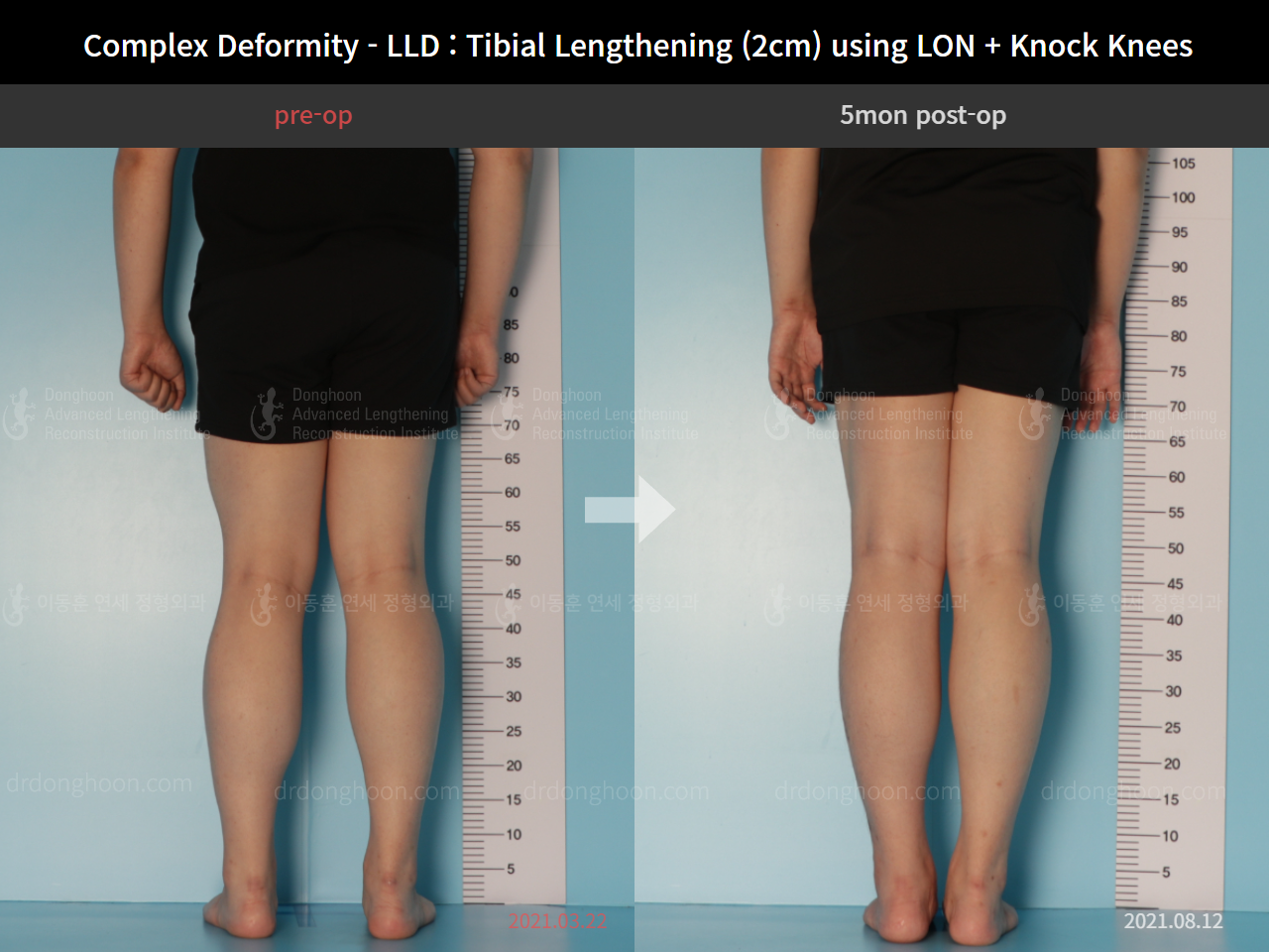 Before and after complex deformity, case 8394665, image 2, Dr. Donghoon institute (DALRI)