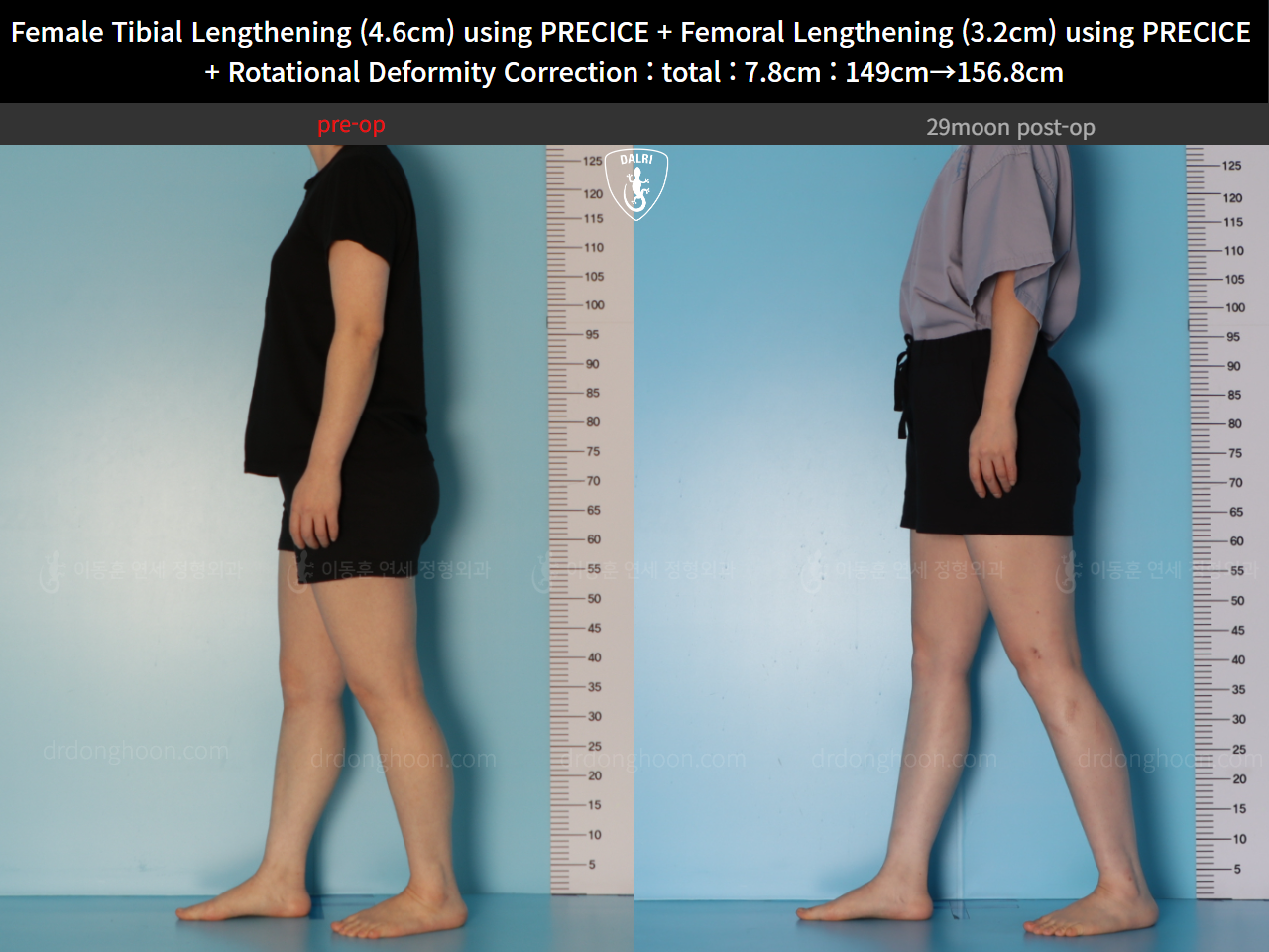 Before and after cll precice, case 123686647, image 6, Dr. Donghoon institute (DALRI)