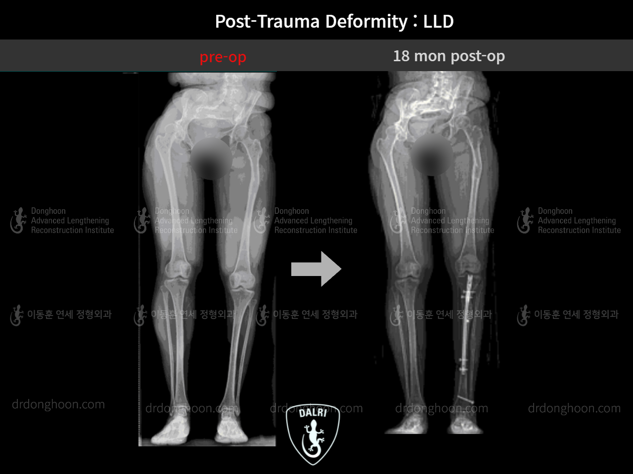 Before and after adult lld, case 9125304, image 7, Dr. Donghoon institute (DALRI)