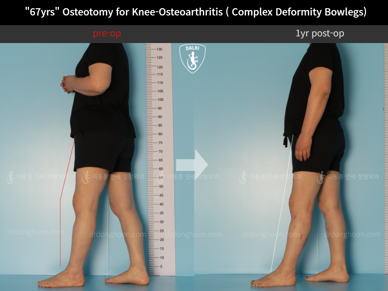 Before and after adult bowlegs, case 11339434, image 4, Dr. Donghoon institute (DALRI)
