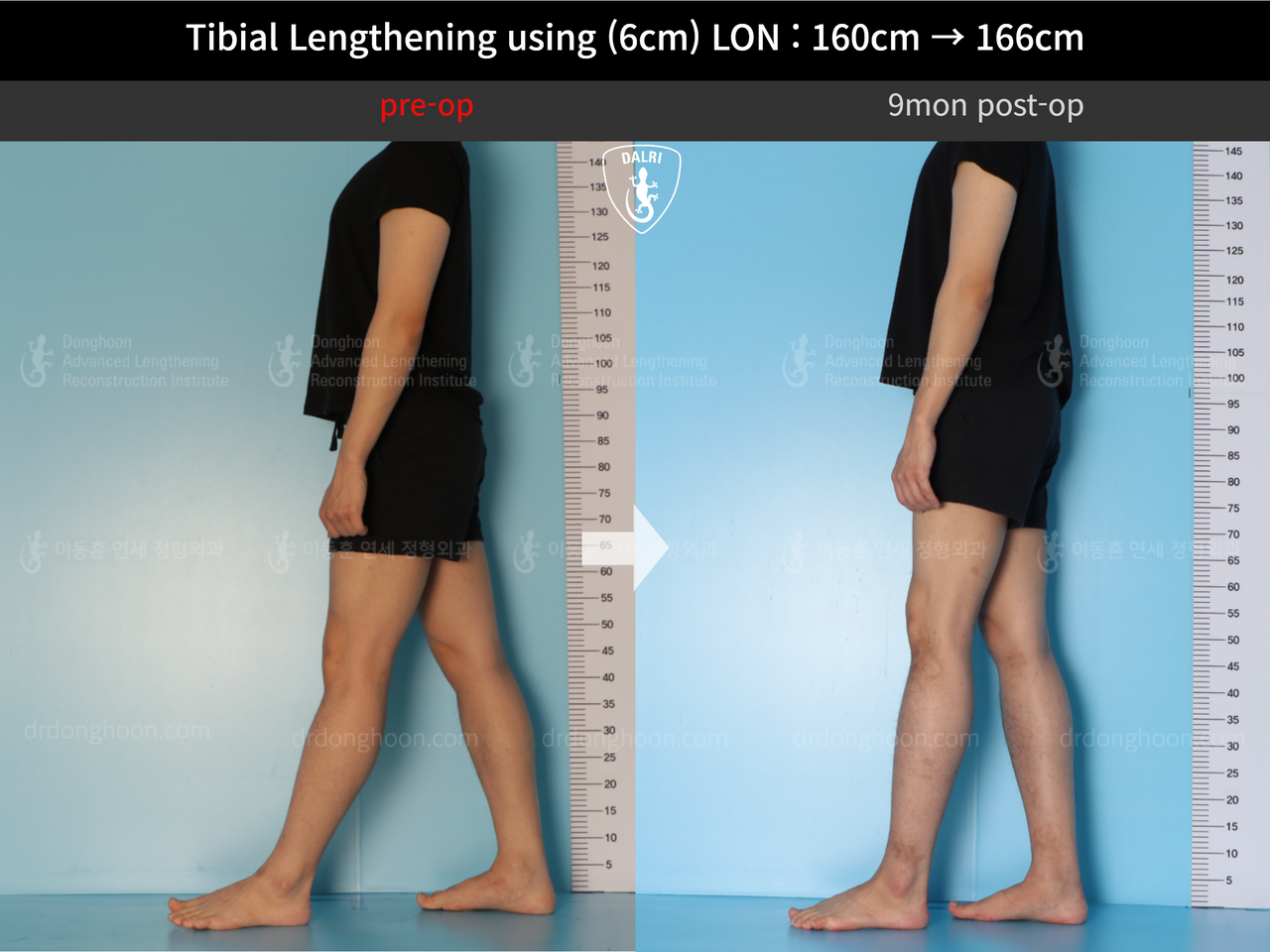 Before and after cll lon, case 13326359, image 5, Dr. Donghoon institute (DALRI)