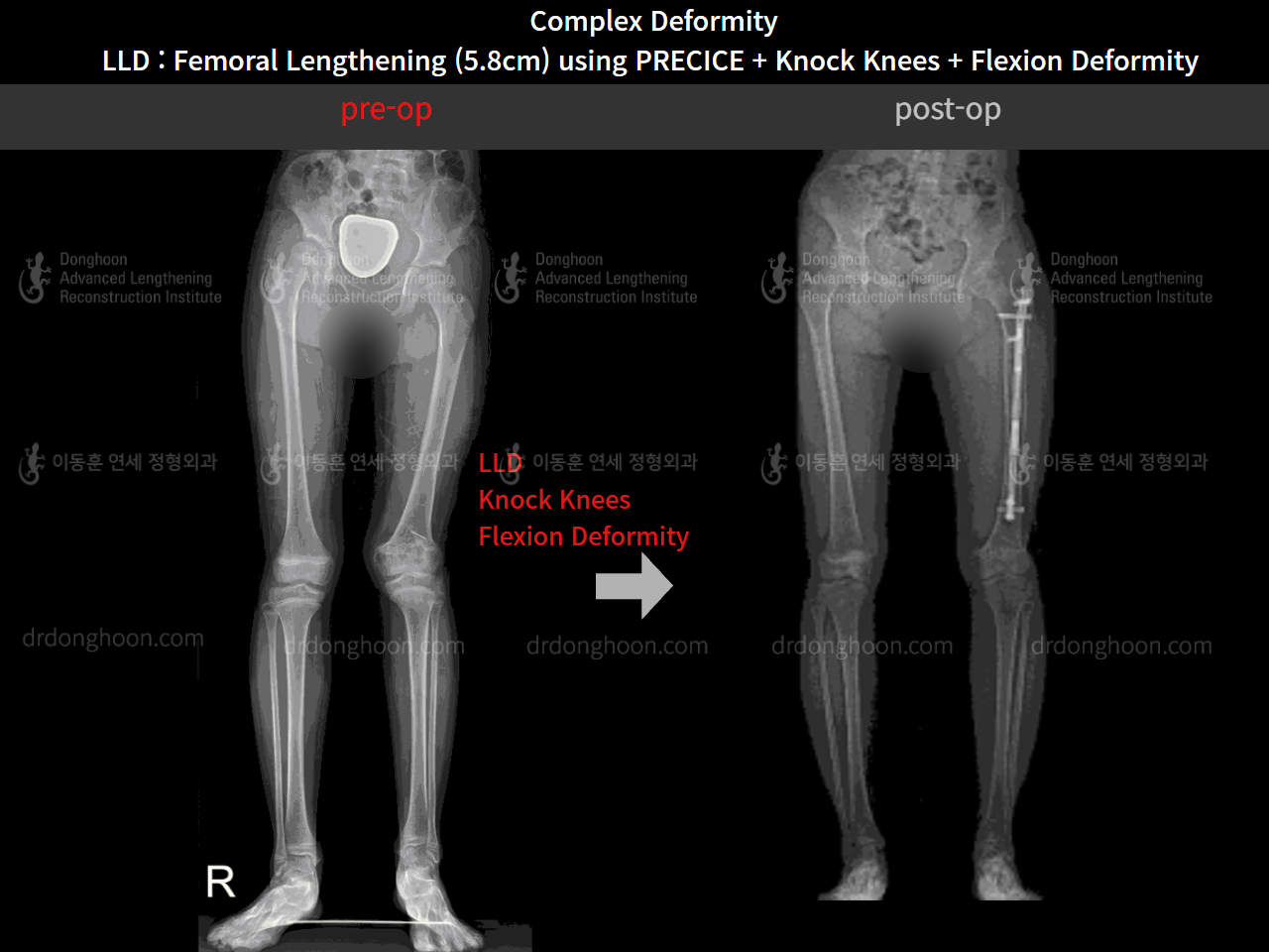 Before and after complex deformity, case 8790512, image 7, Dr. Donghoon institute (DALRI)
